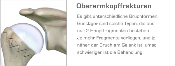 oberarmkopffraktur